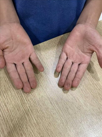 9歲小學(xué)生長(zhǎng)期拍煙卡，手部粗糙長(zhǎng)繭。受訪者供圖